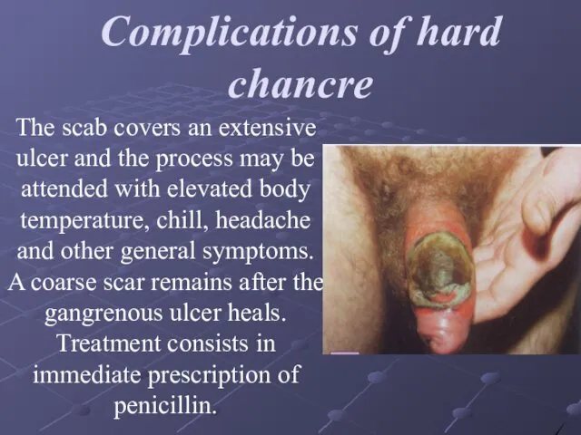 Complications of hard chancre The scab covers an extensive ulcer