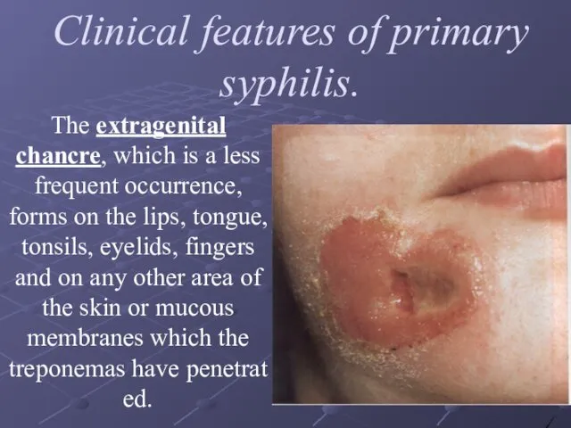 Clinical features of primary syphilis. The extragenital chancre, which is