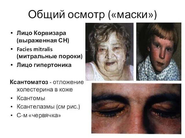 Общий осмотр («маски») Лицо Корвизара (выраженная СН) Facies mitralis (митральные пороки) Лицо гипертоника