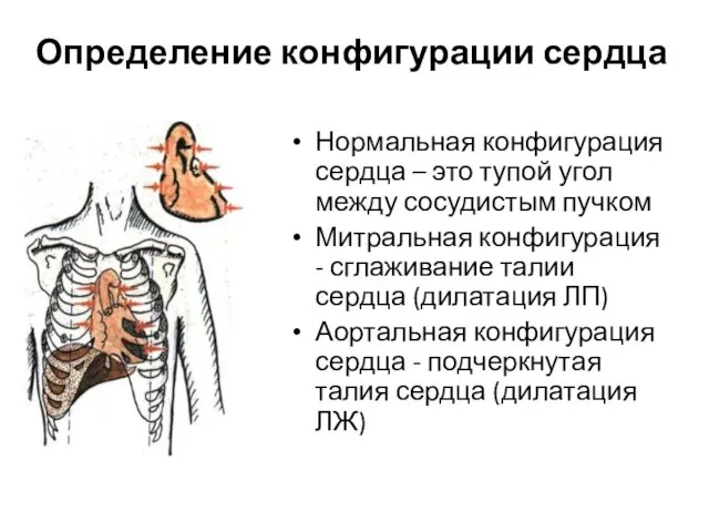 Определение конфигурации сердца Нормальная конфигурация сердца – это тупой угол между сосудистым пучком