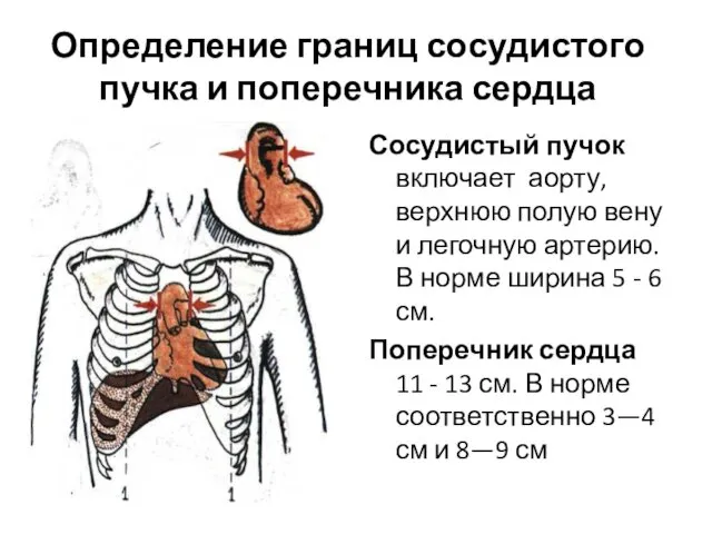 Определение границ сосудистого пучка и поперечника сердца Сосудистый пучок включает аорту, верхнюю полую