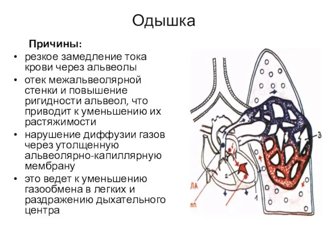 Одышка Причины: резкое замедление тока крови через альвеолы отек межальвеолярной