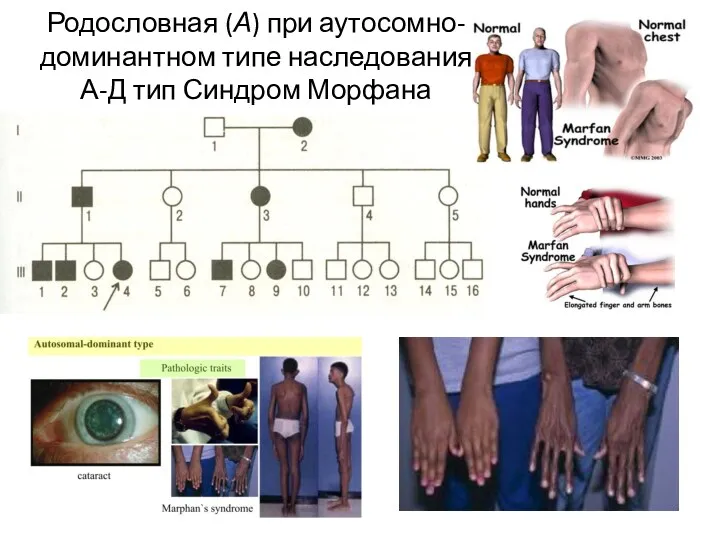 Родословная (А) при аутосомно-доминантном типе наследования А-Д тип Синдром Морфана