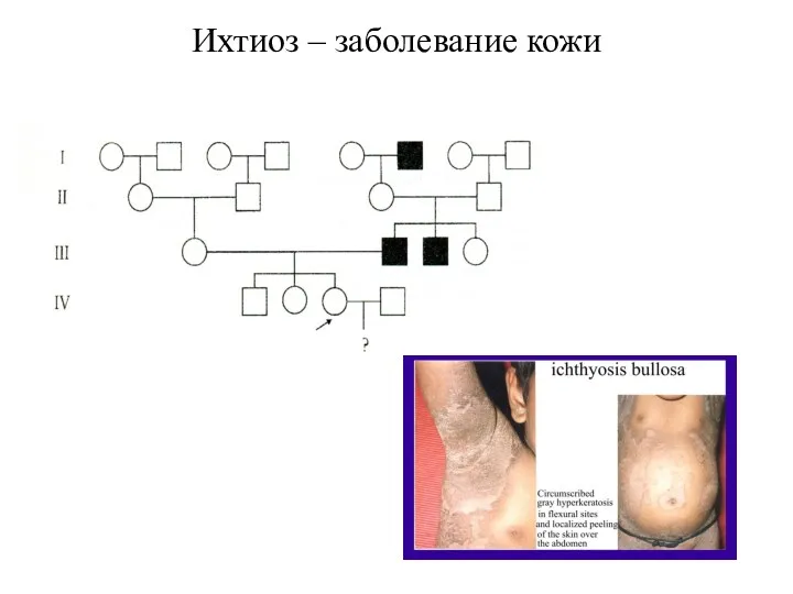 Ихтиоз – заболевание кожи