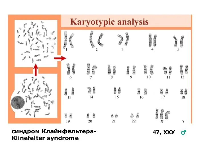 синдром Клайнфельтера- Klinefelter syndrome 47, ХХУ ♂