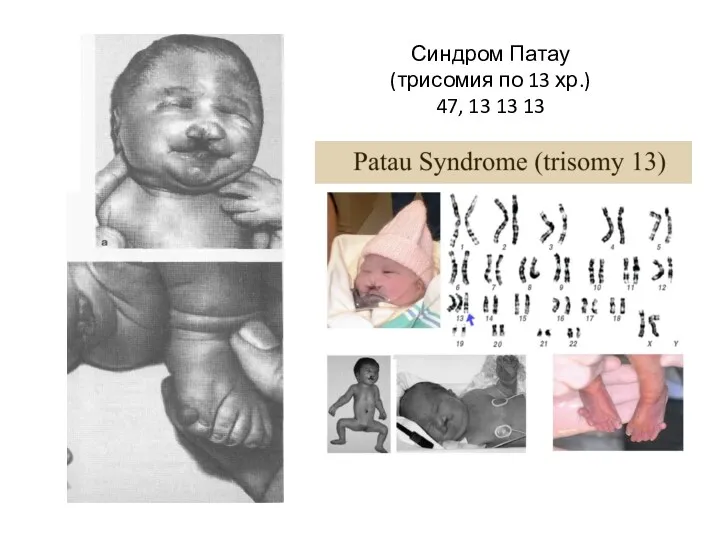 Синдром Патау (трисомия по 13 хр.) 47, 13 13 13