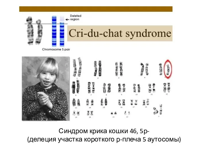 Синдром крика кошки 46, 5р- (делеция участка короткого р-плеча 5 аутосомы)