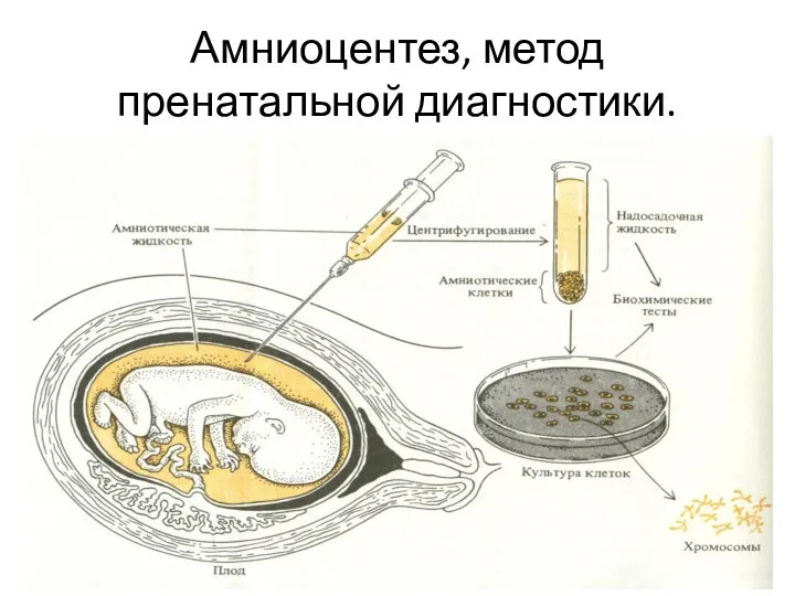 Амниоцентез, метод пренатальной диагностики.