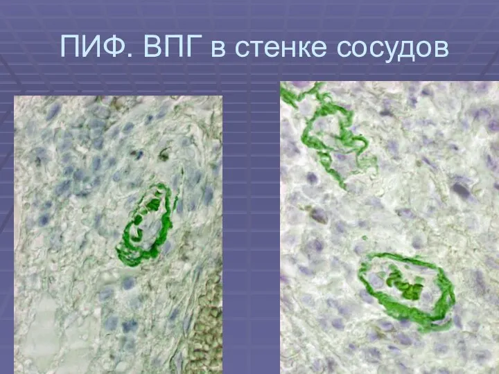 ПИФ. ВПГ в стенке сосудов