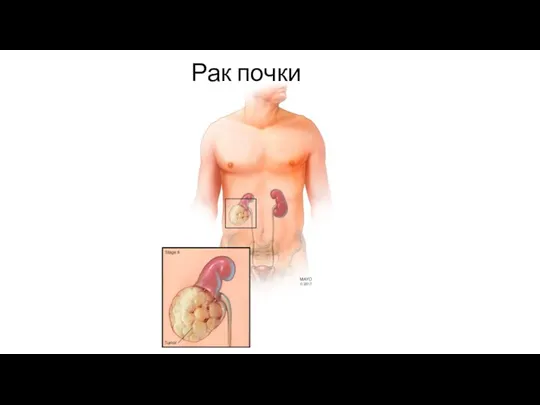 Рак почки