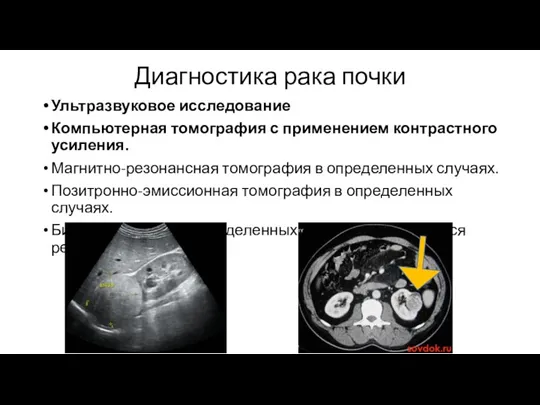 Диагностика рака почки Ультразвуковое исследование Компьютерная томография с применением контрастного