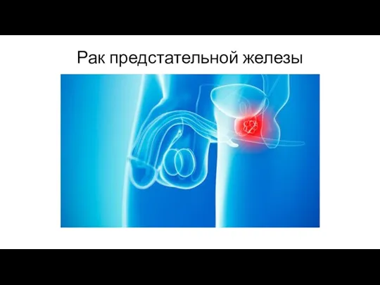 Рак предстательной железы