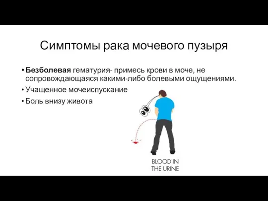 Симптомы рака мочевого пузыря Безболевая гематурия- примесь крови в моче,