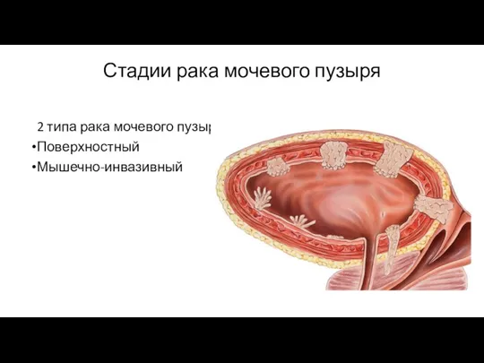 Стадии рака мочевого пузыря 2 типа рака мочевого пузыря Поверхностный Мышечно-инвазивный