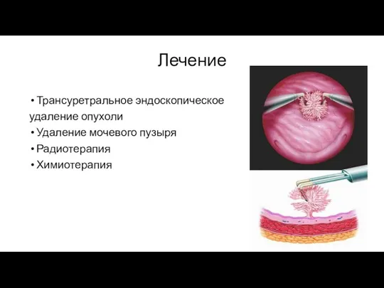 Лечение Трансуретральное эндоскопическое удаление опухоли Удаление мочевого пузыря Радиотерапия Химиотерапия