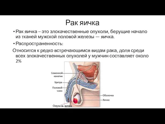 Рак яичка Рак яичка – это злокачественные опухоли, берущие начало