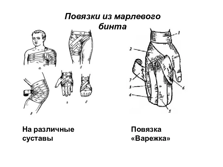 Повязки из марлевого бинта На различные суставы Повязка «Варежка»