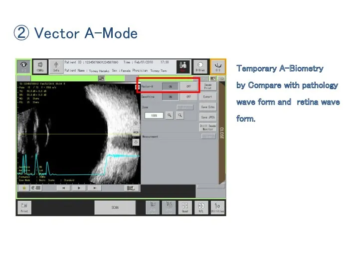 ② Vector A-Mode Temporary A-Biometry by Compare with pathology wave form and retina wave form.