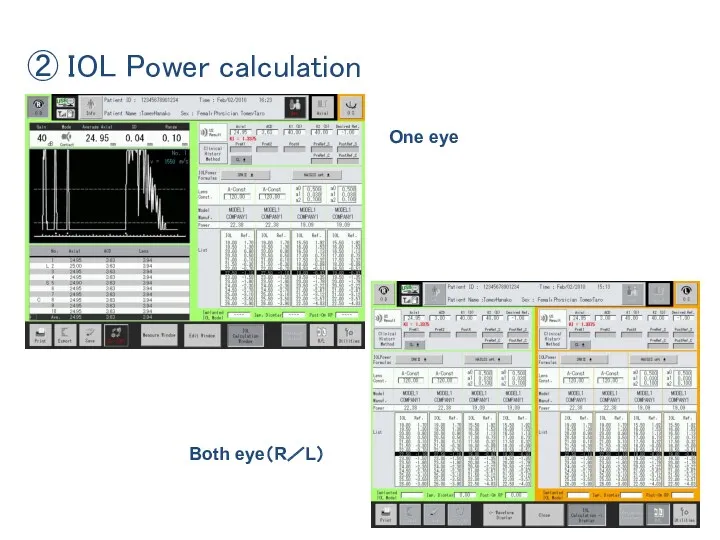 ② IOL Power calculation One eye Both eye（R／L）