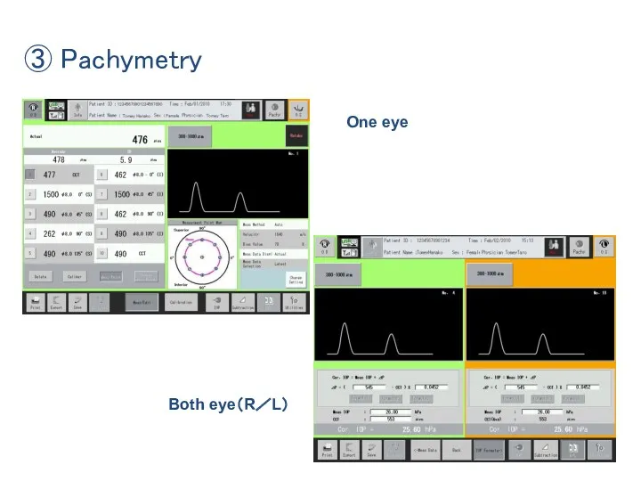 ③ Pachymetry One eye Both eye（R／L）