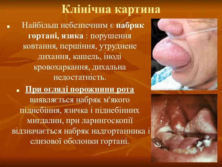 Клінічна картина Найбільш небезпечним є набряк гортані, язика : порушення