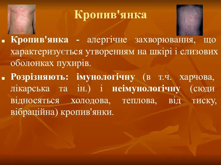 Кропив'янка Кропив'янка - алергічне захворювання, що характеризується утворенням на шкірі