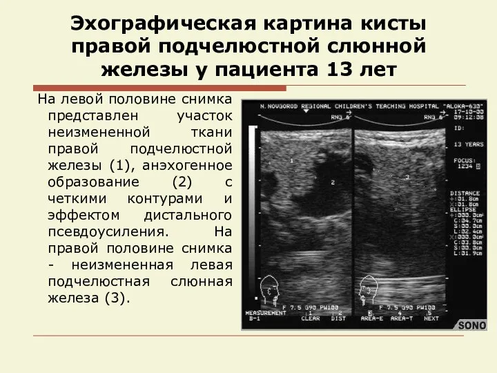 Эхографическая картина кисты правой подчелюстной слюнной железы у пациента 13