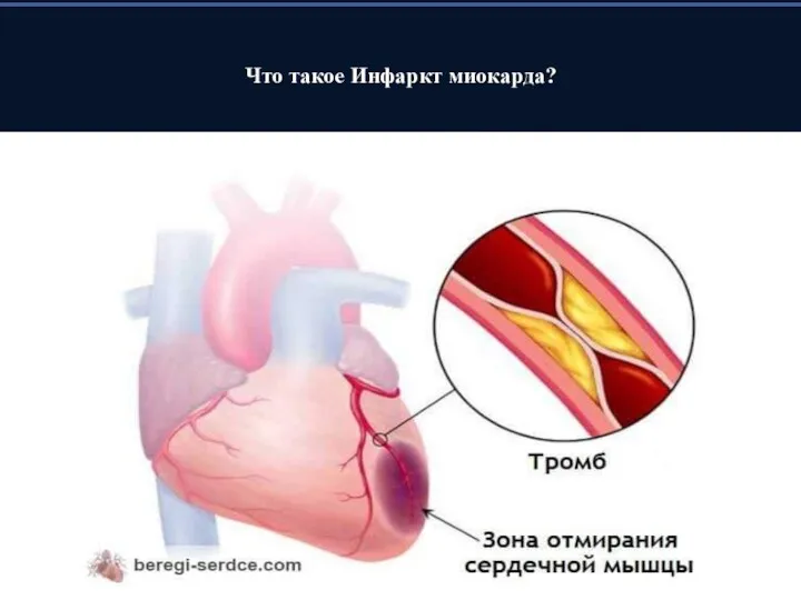 Что такое Инфаркт миокарда?