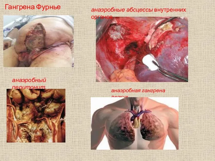 Гангрена Фурнье анаэробный перитонит. анаэробная гангрена легких. анаэробные абсцессы внутренних органов