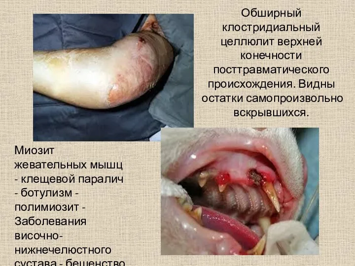 Обширный клостридиальный целлюлит верхней конечности посттравматического происхождения. Видны остатки самопроизвольно