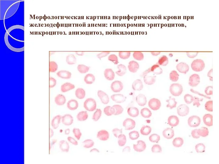 Морфологическая картина периферической крови при железодефицитной анеми: гипохромия эритроцитов, микроцитоз. анизоцитоз, пойкилоцитоз