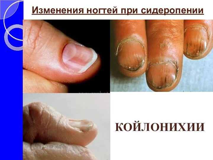 Изменения ногтей при сидеропении КОЙЛОНИХИИ