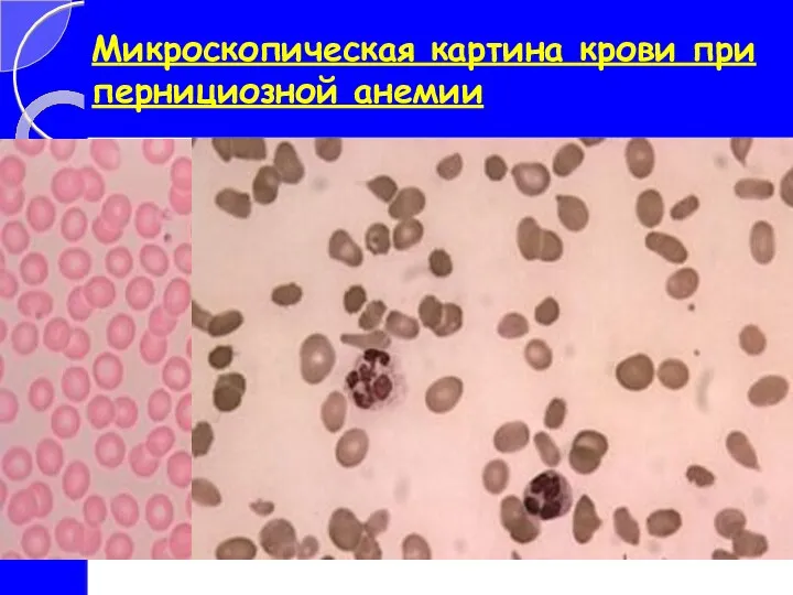 Микроскопическая картина крови при пернициозной анемии