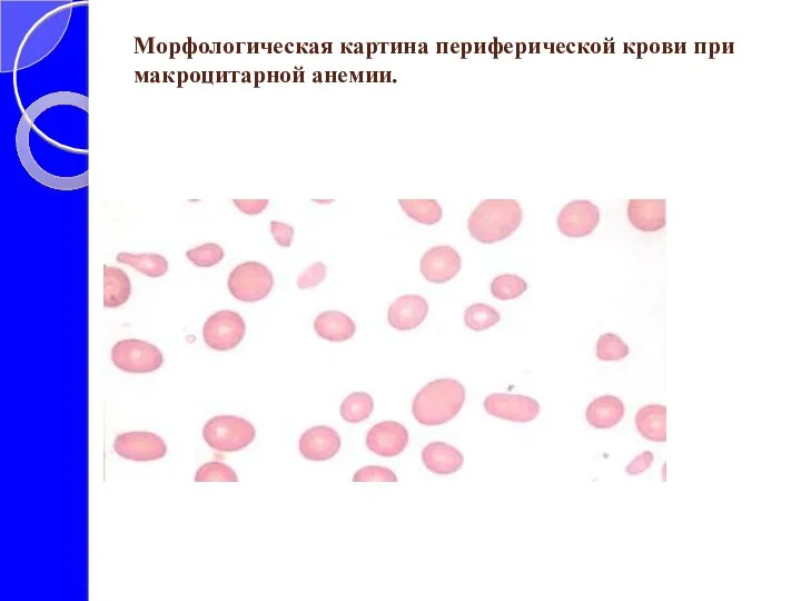 Морфологическая картина периферической крови при макроцитарной анемии.