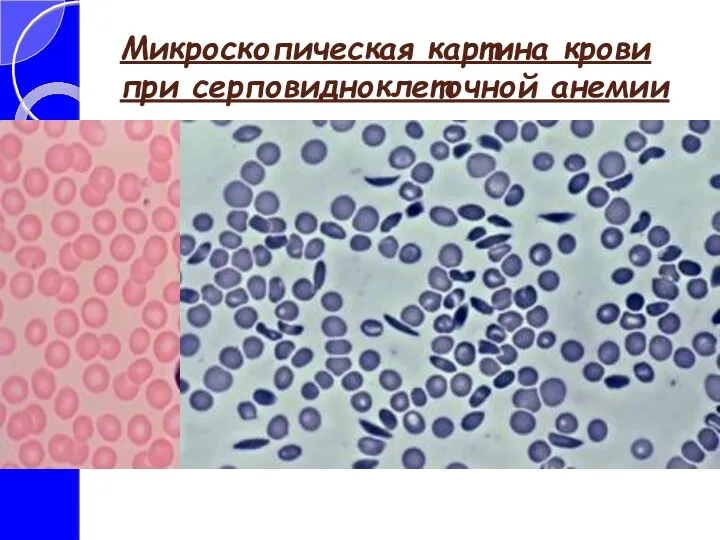 Микроскопическая картина крови при серповидноклеточной анемии