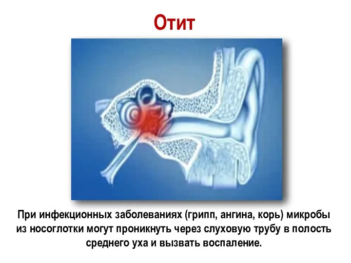 Отит При инфекционных заболеваниях (грипп, ангина, корь) микробы из носоглотки