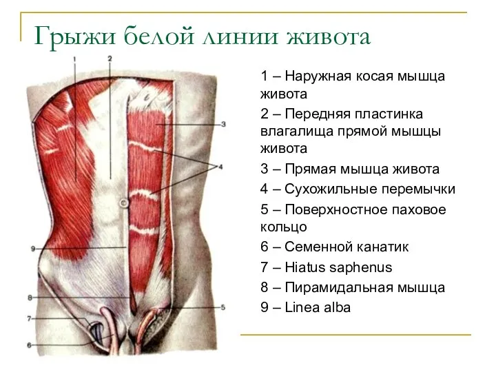 Грыжи белой линии живота 1 – Наружная косая мышца живота