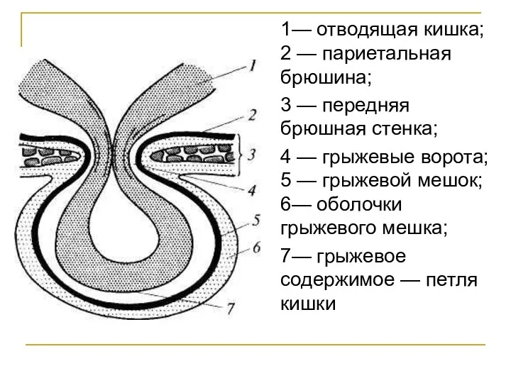 1— отводящая кишка; 2 — париетальная брюшина; 3 — передняя