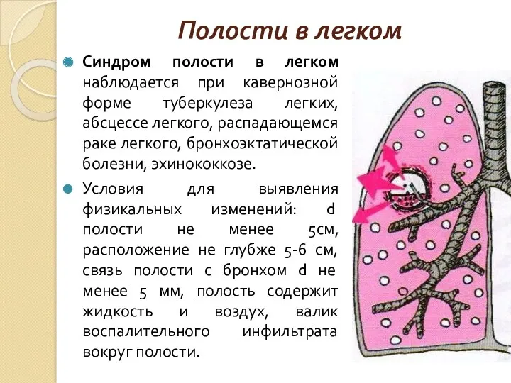 Полости в легком Синдром полости в легком наблюдается при кавернозной