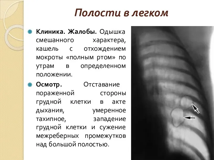 Клиника. Жалобы. Одышка смешанного характера, кашель с отхождением мокроты «полным ртом» по утрам