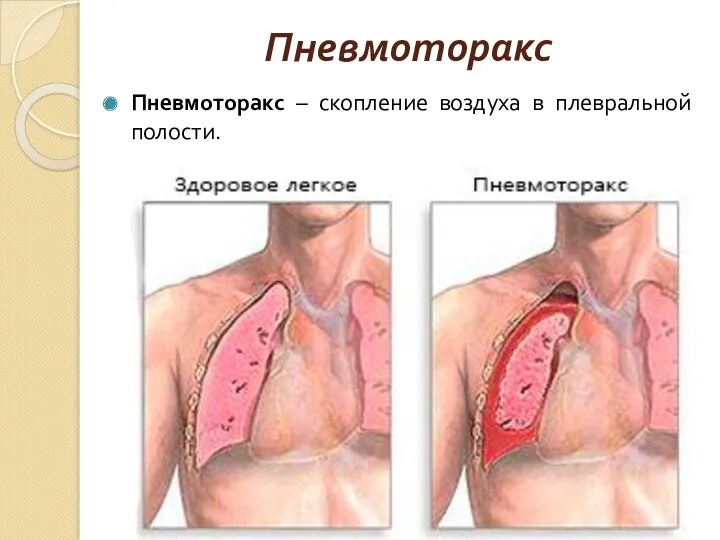 Пневмоторакс Пневмоторакс – скопление воздуха в плевральной полости.