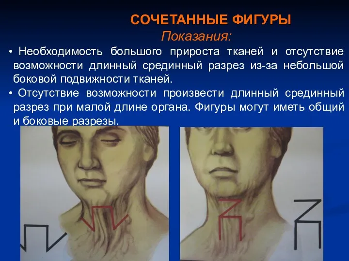 СОЧЕТАННЫЕ ФИГУРЫ Показания: Необходимость большого прироста тканей и отсутствие возможности