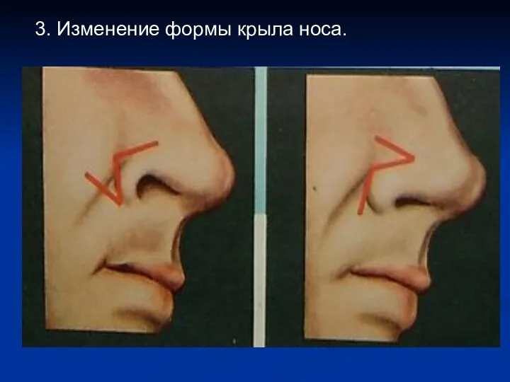3. Изменение формы крыла носа.