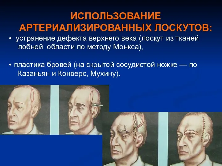 ИСПОЛЬЗОВАНИЕ АРТЕРИАЛИЗИРОВАННЫХ ЛОСКУТОВ: устранение дефекта верхнего века (лоскут из тканей