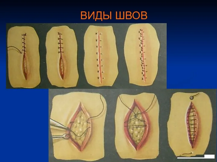 ВИДЫ ШВОВ
