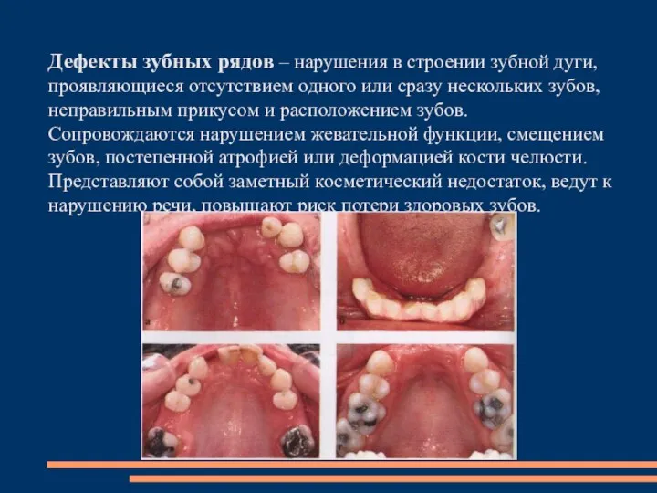 Дефекты зубных рядов – нарушения в строении зубной дуги, проявляющиеся