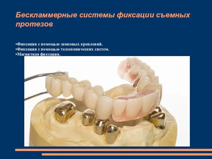 Бескламмерные системы фиксации съемных протезов •Фиксация с помощью замковых креплений.