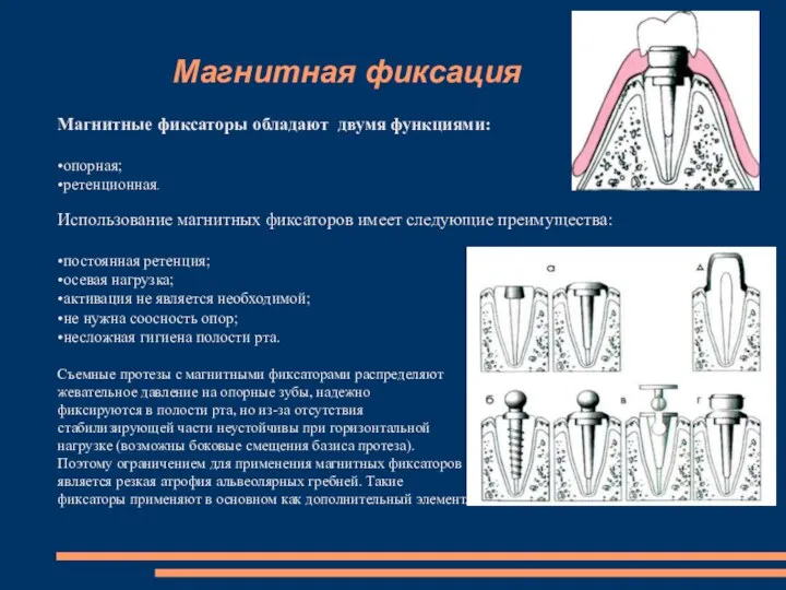 Магнитная фиксация Магнитные фиксаторы обладают двумя функциями: •опорная; •ретенционная. Использование