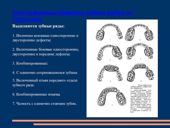 Классификация дефекта зубных рядов по Гаврилову Выделяются зубные ряды: 1.