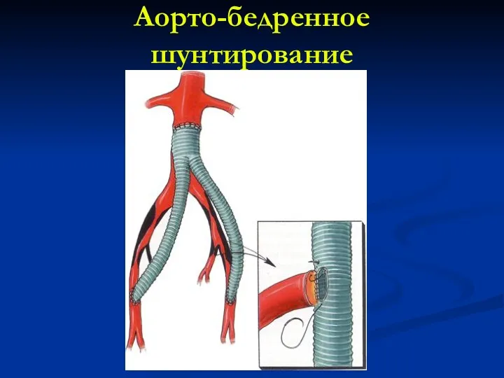 Аорто-бедренное шунтирование